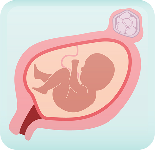 Fibroids: Fertility and Pregnancy