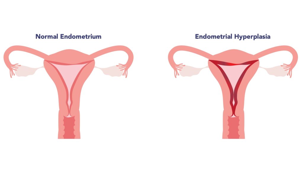 A side-by-side comparison of an illustrated uterus, one showing normal endometrium and one showing an enlarged red lining to represent endometrial hyperplasia.