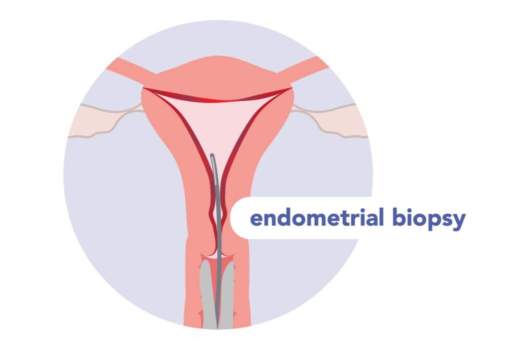 An illustration of a uterus, with an instrument through the cervix and into the uterus to represent a biopsy.