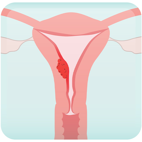 Endometrial Cancer