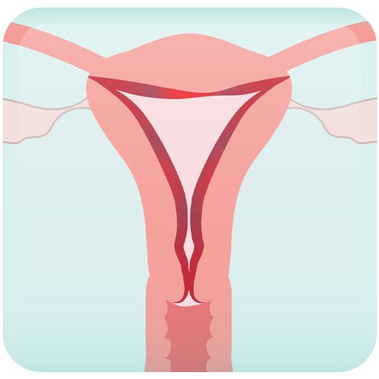 Endometrial Hyperplasia