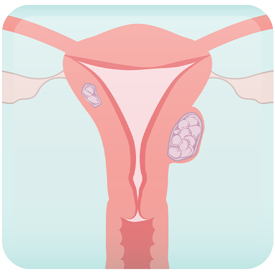 Fibroids