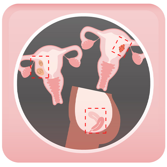 Indications for Hysterectomy