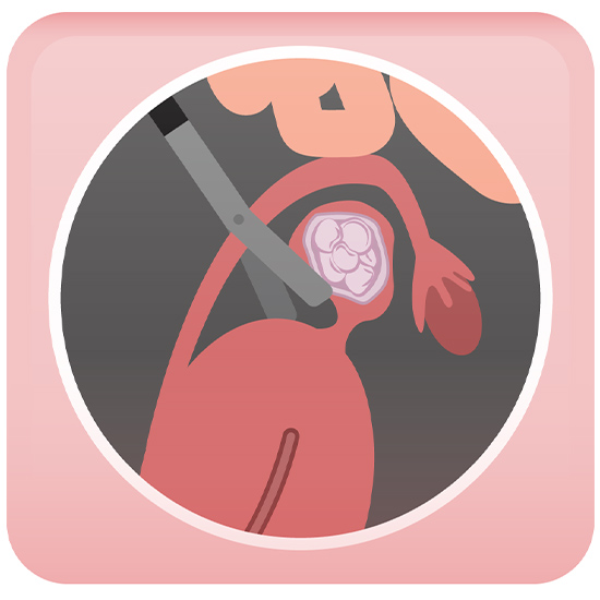 Laparoscopic Myomectomy