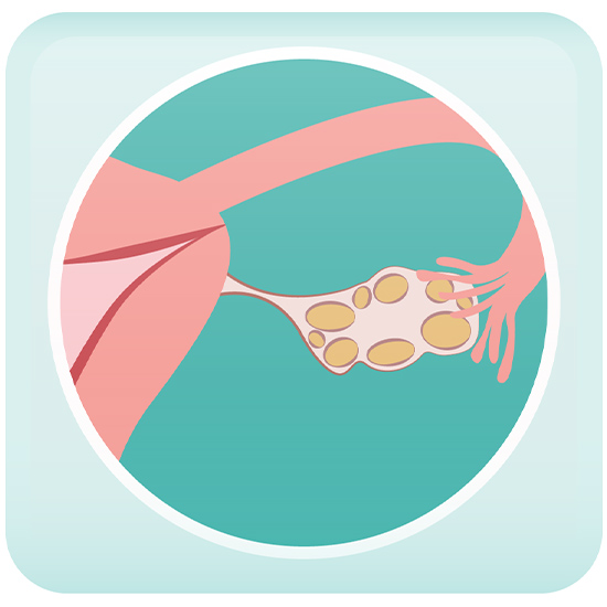 Polycystic Ovary Syndrome