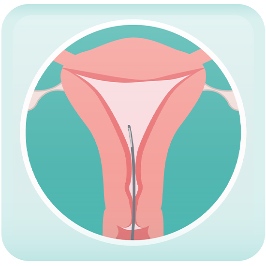 Postmenopausal Bleeding Evaluation