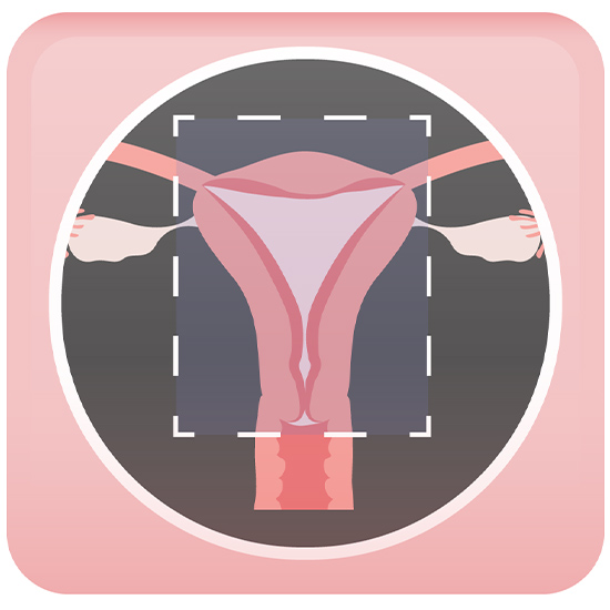 Total Laparoscopic Hysterectomy
