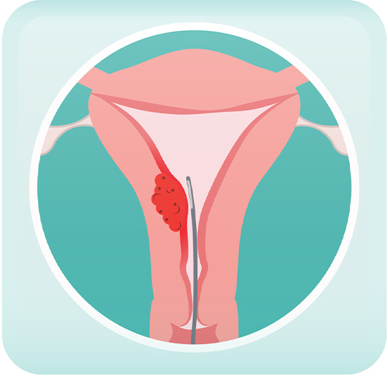 Treatment of Grad 1 Endometrioid Adenocarcin
