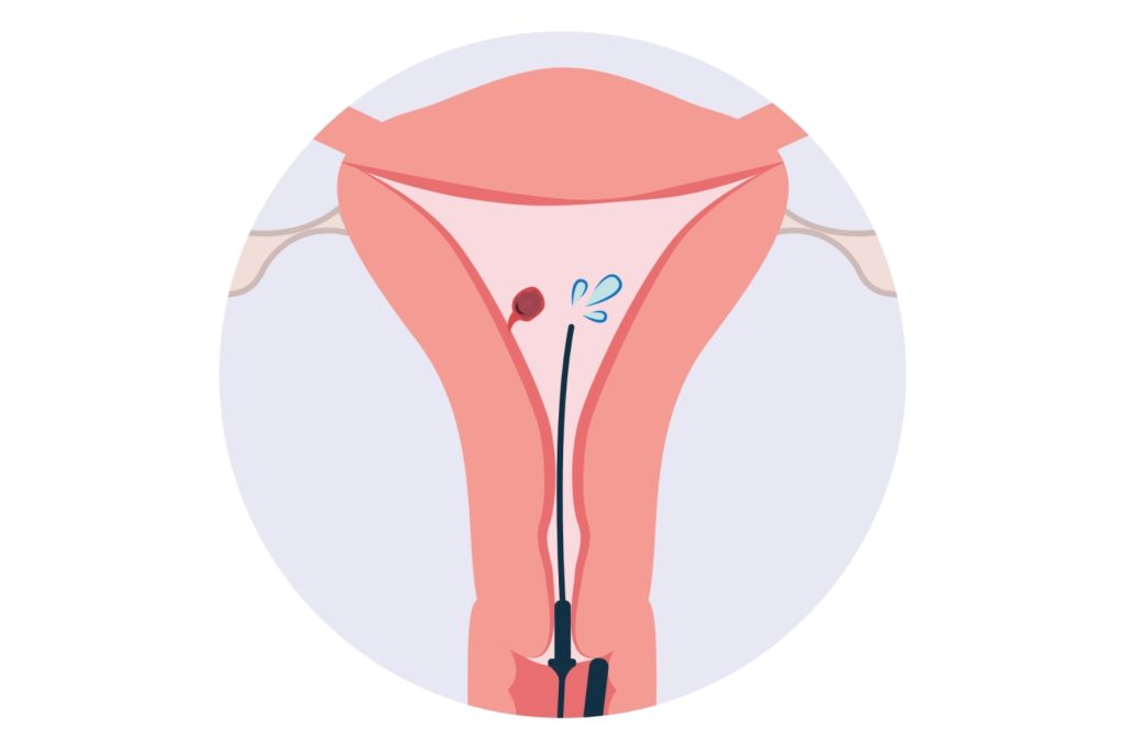An illustration of a uterus showing the process of a sonohysterogram.