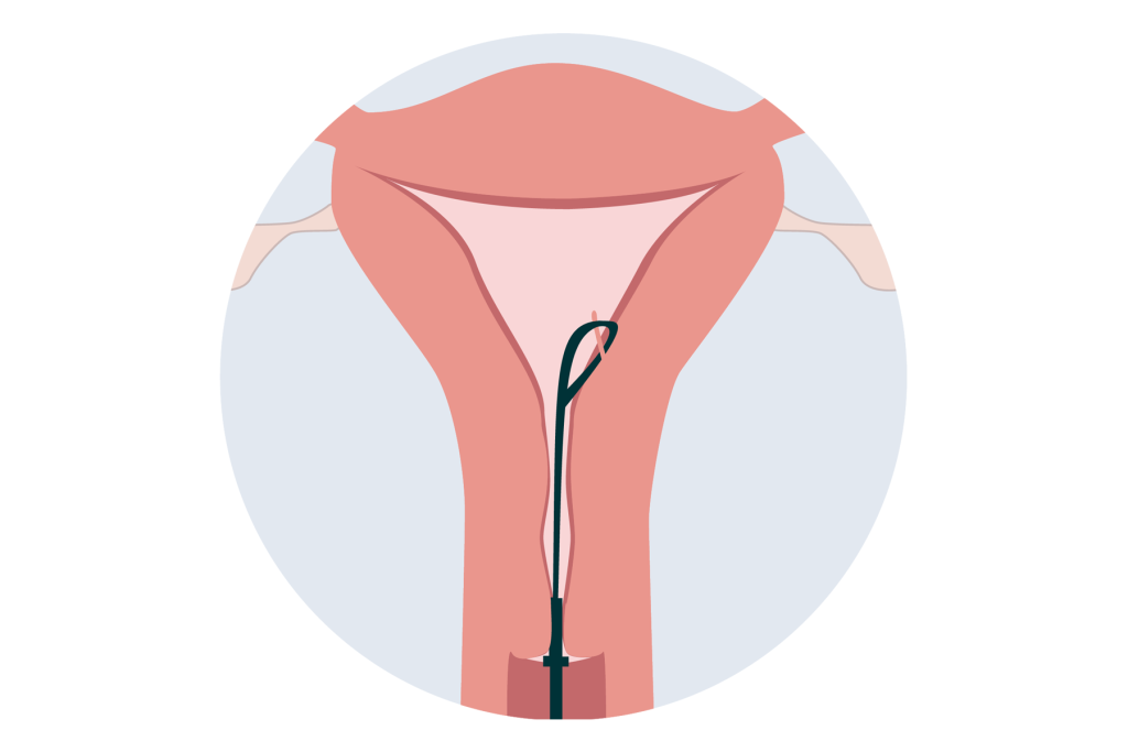 Illustrative diagram of a Dilation and Curettage procedure
