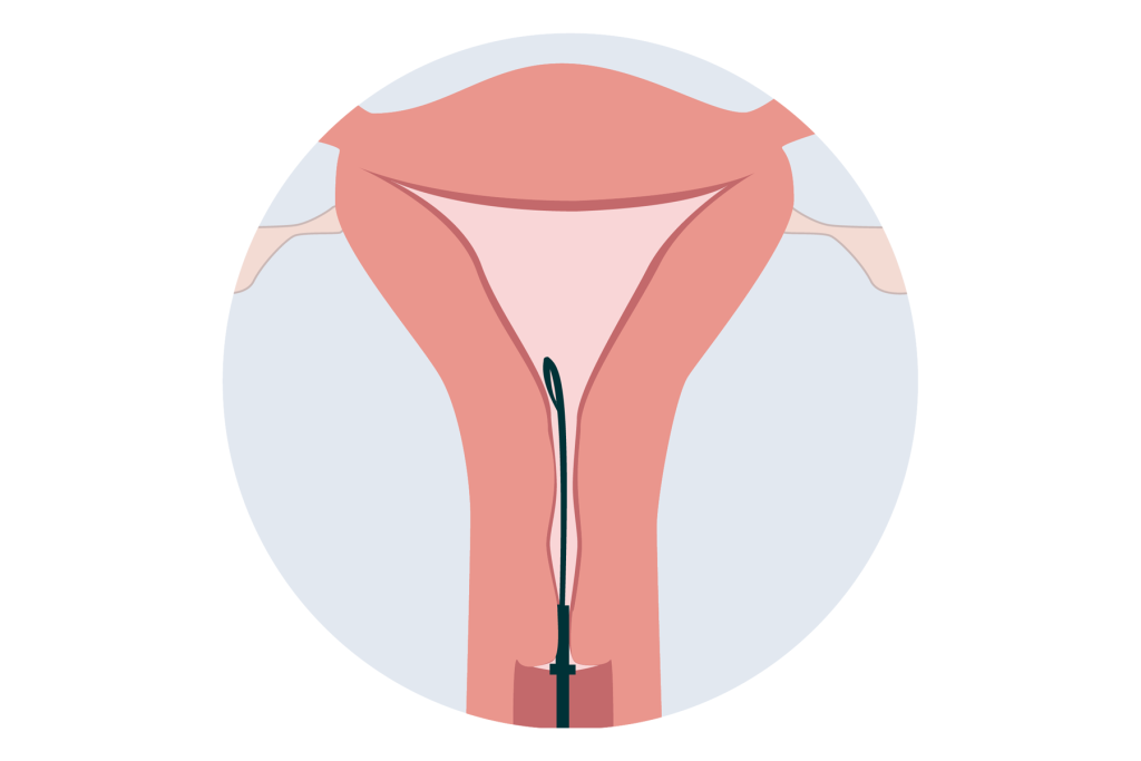 Illustrative diagram of an Endometrial Biopsy procedure