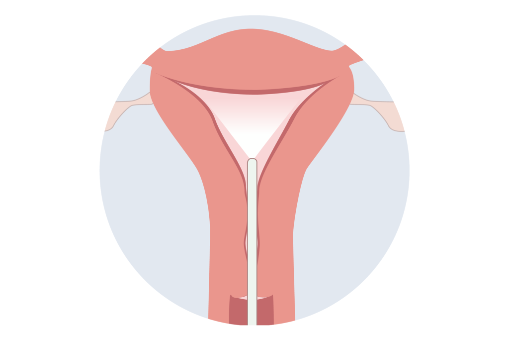 Illustrative diagram of a Hysteroscopy procedure