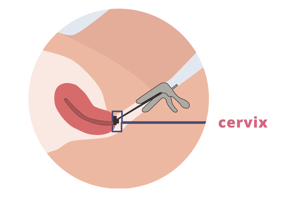 Illustrative diagram of a Pap test procedure