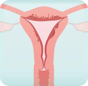 Adenomyosis