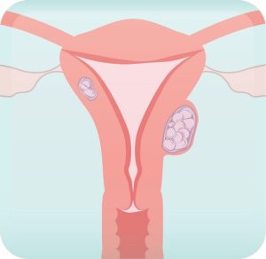 fibroids