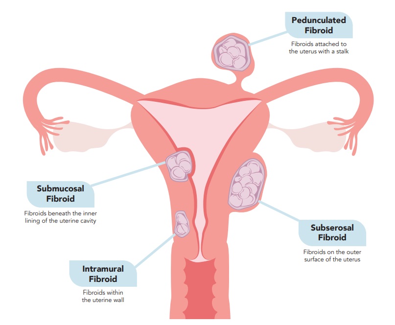 fibroids