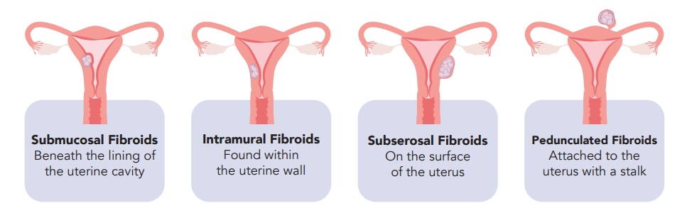 fibroids