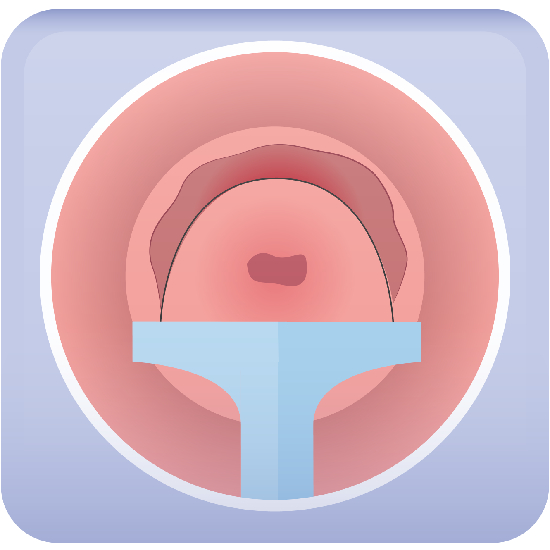 Colposcopy LEEP icon